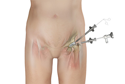 Hip Arthroscopy