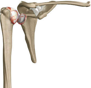 Shoulder Impingement