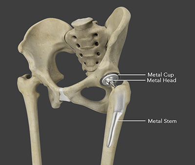 Total Hip Replacement Total Hip Replacement